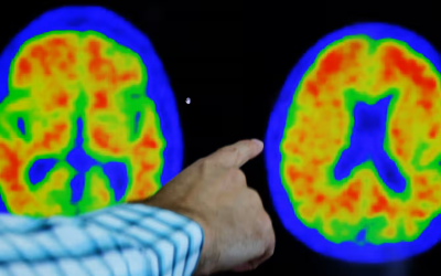Evidence of Alzheimer’s disease on PET scans