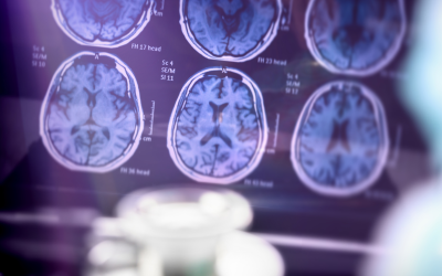 Alzheimers brain scan